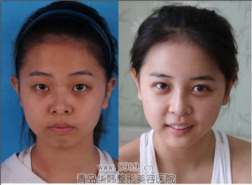 隆眉弓 解锁立体美人骨的秘密 | 华韩美人